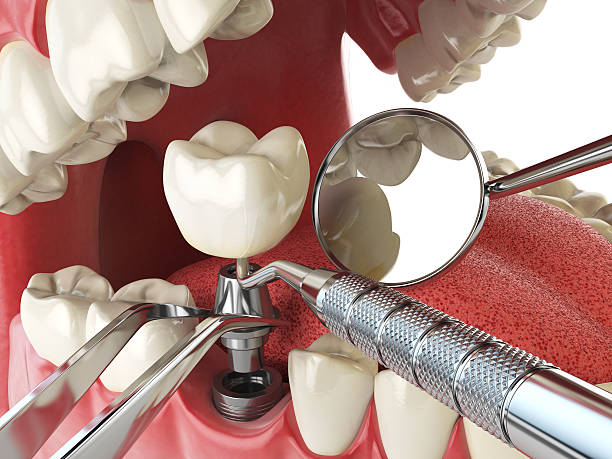 Best Cracked Tooth Emergency Dentist  in Minnehaha, WA